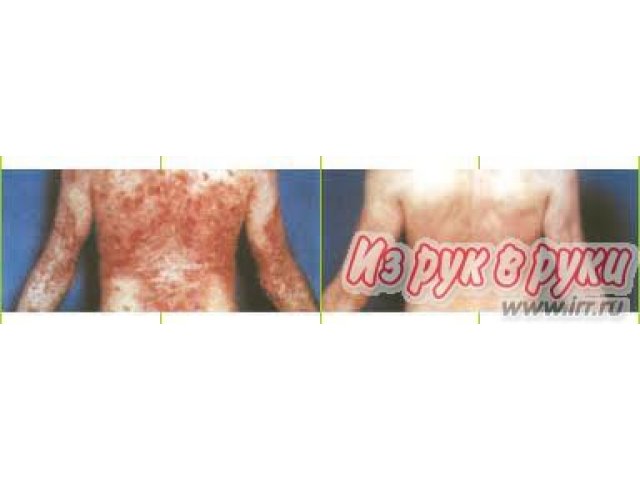 Антипсор эффективен от псориаза и др. кожных заболеванийа в городе Тюмень, фото 3, Тюменская область