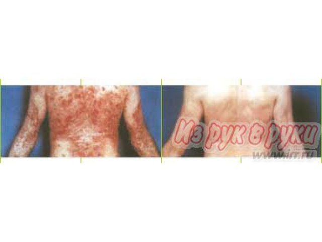 Антипсор:  Эффективное лечение кожных заболеваний в городе Тюмень, фото 2, Медицинская помощь