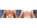 Антипсор:  Эффективное лечение кожных заболеваний в городе Тюмень, фото 2, стоимость: 600 руб.